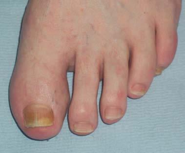 Tender dactylitis count The joints of any digits with dactylitis are not scored separately for the purposes of