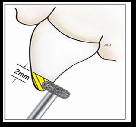 (Fig 10) PASSIVE FIT It is very important that zirconia pedo crowns fit passively because they do not flex and pushing harder will not work. Do not attempt to force a crown to fit.