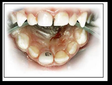 minimize the recurrence of caries under the restorations.