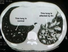 normal This lung is