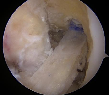 Outcomes ACL