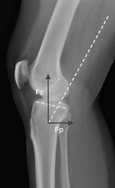Quadriceps Contraction Hamstring Force Balance» The quadricep is the primary producer of anterior force with the knee at/near full extension.