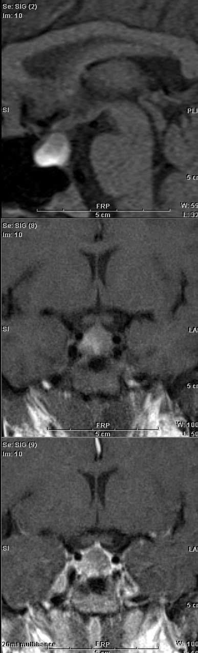 PITUITARY APOPLEXY Infarction pituitary Headache, visual