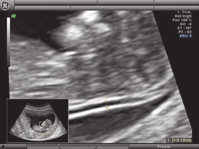 G 4 d G S a HD-Flow in fetal arm with HD-Zoom