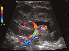 Renal arteryand vein displayed using the 11L probe and a