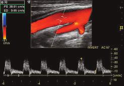 CrossXBeam and SRI features Internal carotid artery with color
