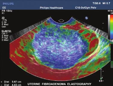 Color elastography map showing gradations of stiffness.