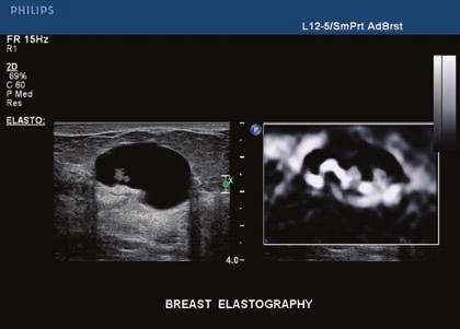 Expanded breast elastography for breast imaging What if you could detect breast abnormalities in a wider range of patients?