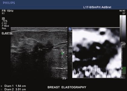 * The L17-5 allows for excellent resolution in superficial structures, and combined with the L12-5, comprises a complete solution for breast elastography to help diagnose and manage breast disease.