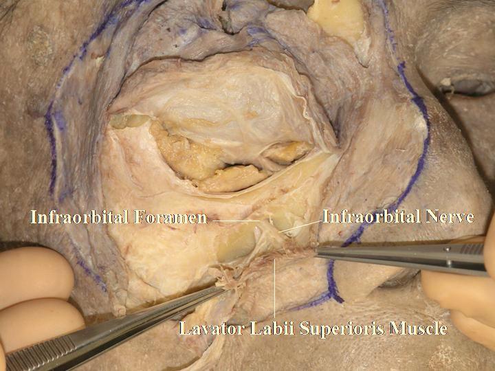 14 The Open Anatomy Journal, 2010, Volume 2 Kakizaki et al. The confluent part between the lower eyelid retractors (LERs) and the orbital septum is seen here.