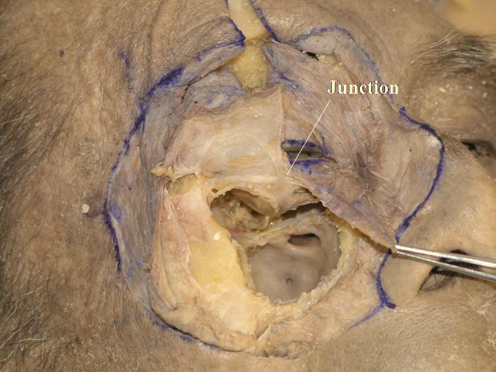 16 The Open Anatomy Journal, 2010, Volume 2 Kakizaki et al. Lockwood s ligament, and the inferior ligament [29]. The ligaments originate from the posterior lacrimal crest.