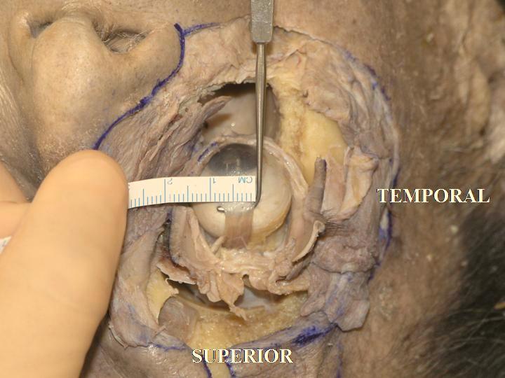 3 mm, that of the inferior rectus muscle is 9.8 mm, the lateral rectus muscle is 9.2 mm and that of the superior rectus muscle is 10.6 mm. Dutton s anatomical textbook presents similar values [41].