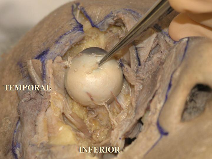 The inferior oblique muscle tendon inserts on the posterolateral hemisphere of the globe in a fan-like fashion [18], in an area around the superior border of the lateral rectus muscle or lightly more