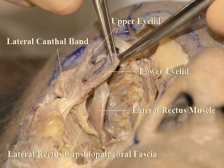 The lateral retinaculum attaches to Whitnall s tubercle.