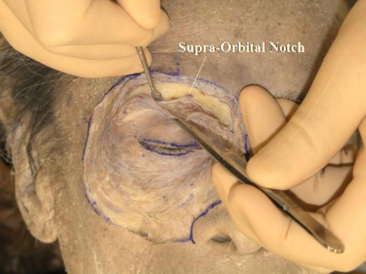 The lateral palpebral raphe is defined as a narrow fibrous band in the lateral part of the OOM formed by the interlacing of fibres passing through the upper and lower eyelids [5].