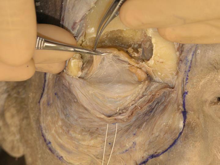 The periorbit is removed completely and the orbital fat can be easily visualized. J. The orbital fat is carefully removed to expose the LPS muscle and its surrounding structures (Fig. 2-12). Fig.