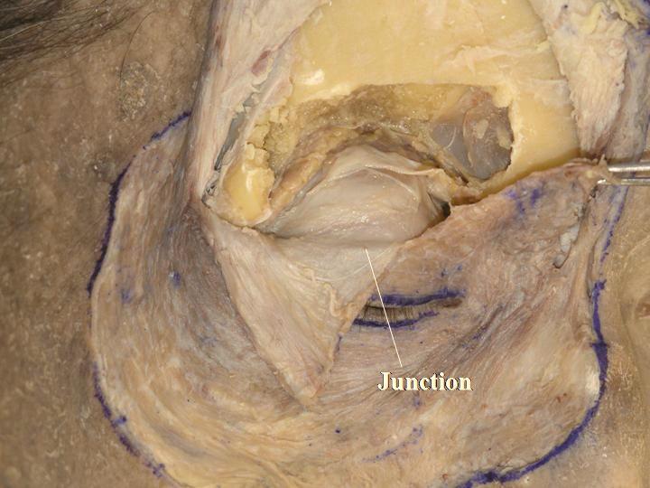 10 The Open Anatomy Journal, 2010, Volume 2 Kakizaki et al. Detailed Anatomy: The LPTL connects the anterior surface of the trochlea and Whitnall s tubercle [13].