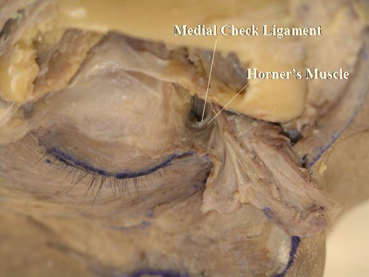 Detailed Anatomy: The MHSL connects the trochlea, Whitnall s ligament, medial horn of the levator aponeurosis and medial orbital rim [15].