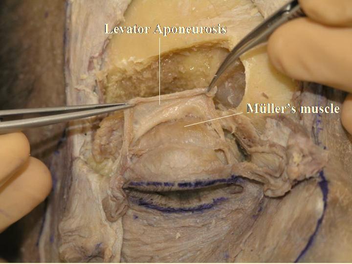 12 The Open Anatomy Journal, 2010, Volume 2 Kakizaki et al. T. The space between the levator aponeurosis and the Müller s muscle (post-aponeurotic space) is exposed (Fig.