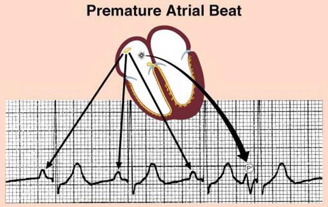 Atrial ectopic beat Premature Normal SVE Premature Occurs in diastolic period of preceding sinus beat Seen earlier than