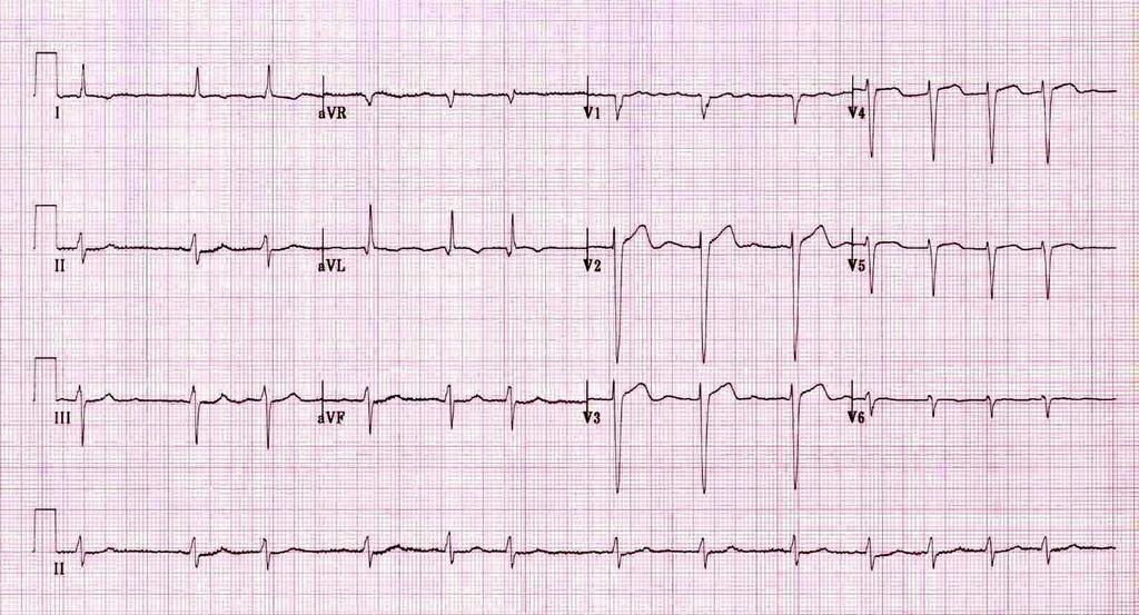 Fine AF ECG Rhythm interpretation process Is there a clear definable P wave? NO 2. Is there 1 QRS for every P wave? N/A (no P waves) 3.