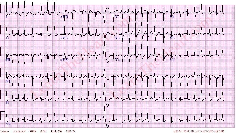 Fast Atrial fibrillation No P clear definable