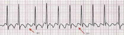 a pattern Ventricular Rhythm more likely