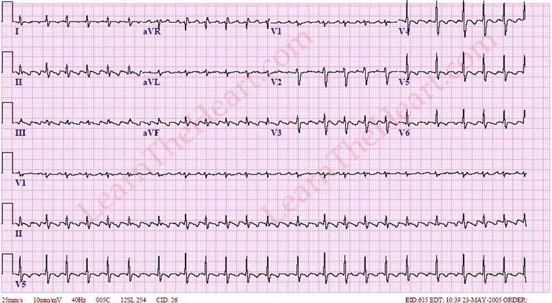 Atrial flutter variable block No clear definable P waves