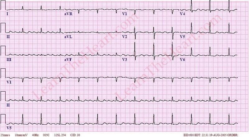 Atrial flutter 3:1 block No clear definable P waves Flutter Waves saw-tooth