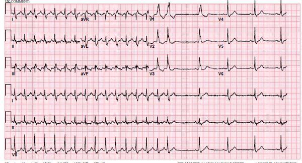 Initial ECG (SVT) No P waves visible QRS normal / narrow RR regular HR 150BPM Post
