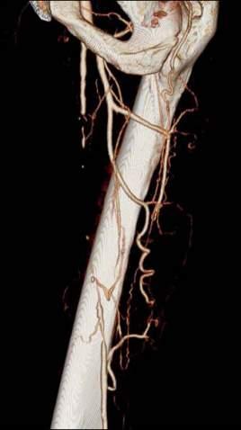 Occluded superficial femoral artery Computed tomography angiography