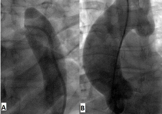 Figure-1 A: Retrograde contrast injection reveals no contrast in the