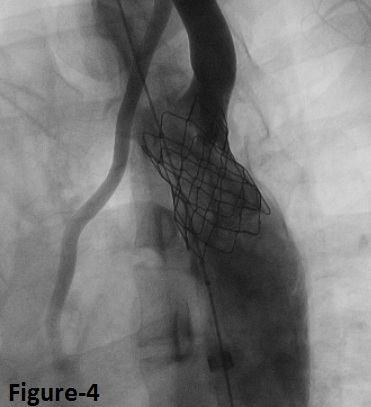 showing atresia of aortic isthmus.