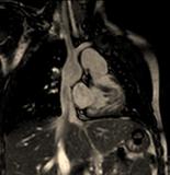 Cardiovascular MRI of Adult Congenital Heart Di