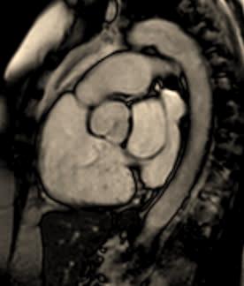 CMR ACHD. Right Heart enlargement. PHTN.? Cause Right heart enlargement Pulmonary HTN? Cause. Coronary sinus ASD LA Unroofed CS RA CS CS Qp/Qs 2.6: 1. Marked RV enlargement. RV EF 48%.
