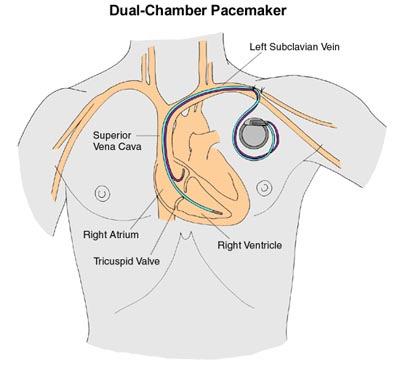 Pacemaker 2/14/2010 29 2. Bradycardia: 3.