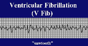 EKG of Ventricular Fibrillation 2/14/2010 31 IX Heart Failure A. Heart Failure: B.