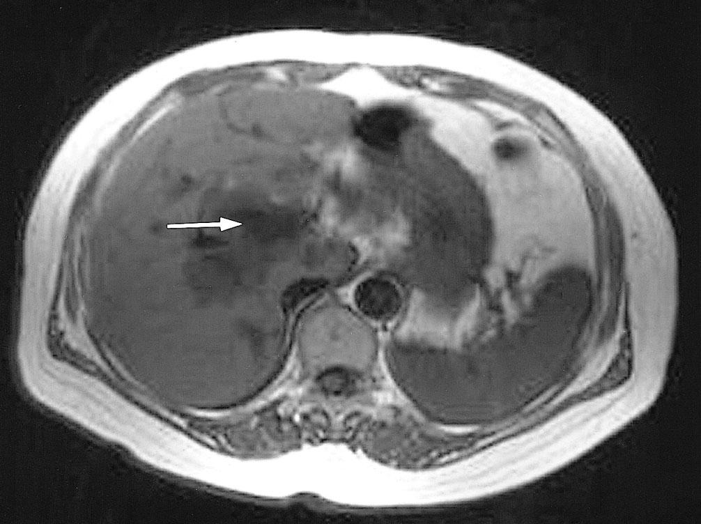 Both of sono-guide liver biopsy of IHD s wall lesion and intraoperative biospy of CBD s wall lesion showed papillary adenoma.