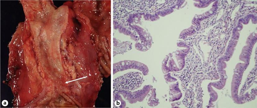 IDUS (b) and POCS (c) revealed an exophytic papillary lesion in the intrapancreatic bile duct. Fig. 3.