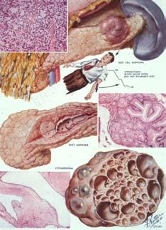 Painless jaundice Islet Cell Tumors