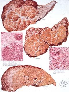 cirrhosis Common features Irreversible Chronic inflammation Scarring (fibrosis) Parenchymal loss Regenerative nodules Altered