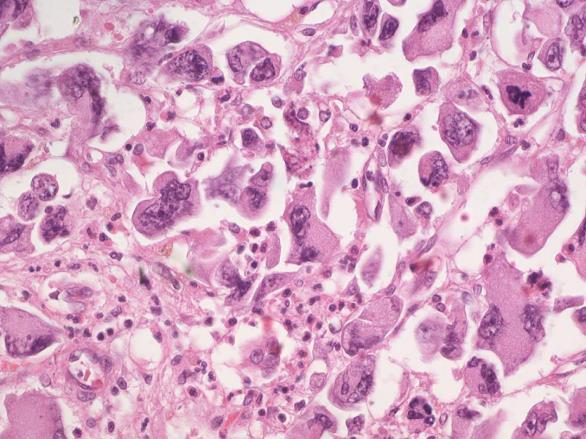 mononuclear cells containing abundant eosinophilic cytoplasm admixed with bizarre frequently multinucleated tumor