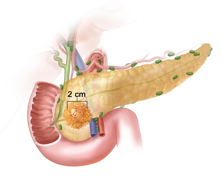 pt2: Tumor limited to the pancreas, 2 to 4 cm pt2 Adapted from https://www.cancer.