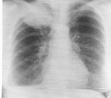 Pulmonary collapse, consolidation, fibrosis. Pneumothorax. Pleural caps.