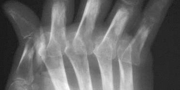 Late changes Juxta-articular articular osteoporosis Ulnar