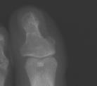 Gout AP view Erosion medial head of 1 st metatarsal away from joint Soft