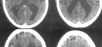 Brain Atrophy CT brain