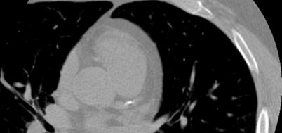 Coronary CTA CT Cardiac Scoring Non-invasively evaluate coronary
