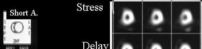 Stress Rest Thallium Scan