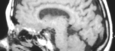 Brain Atrophy T1 Sagittal (CSF Black)